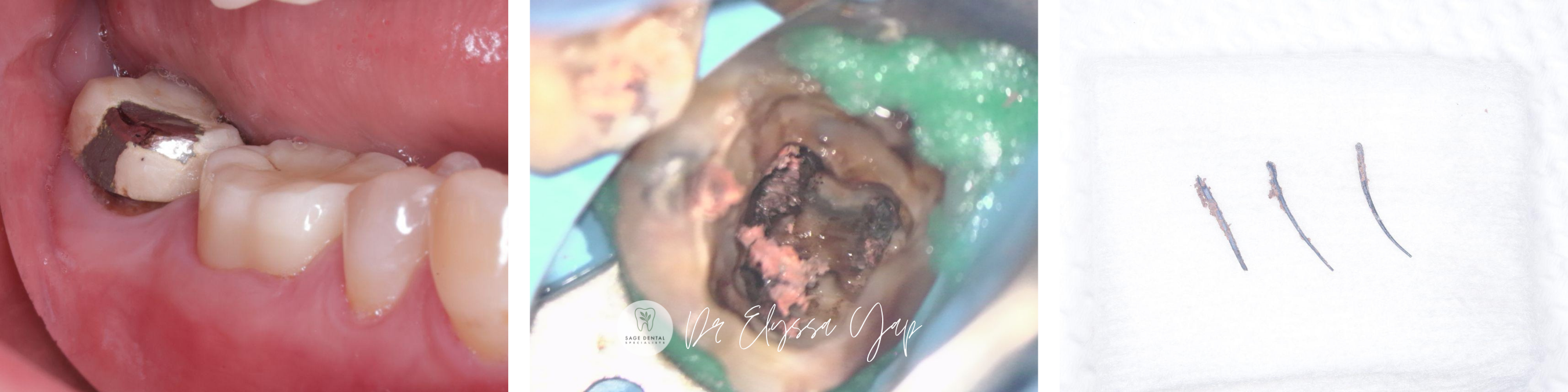 removal of defective crown and old root canal material