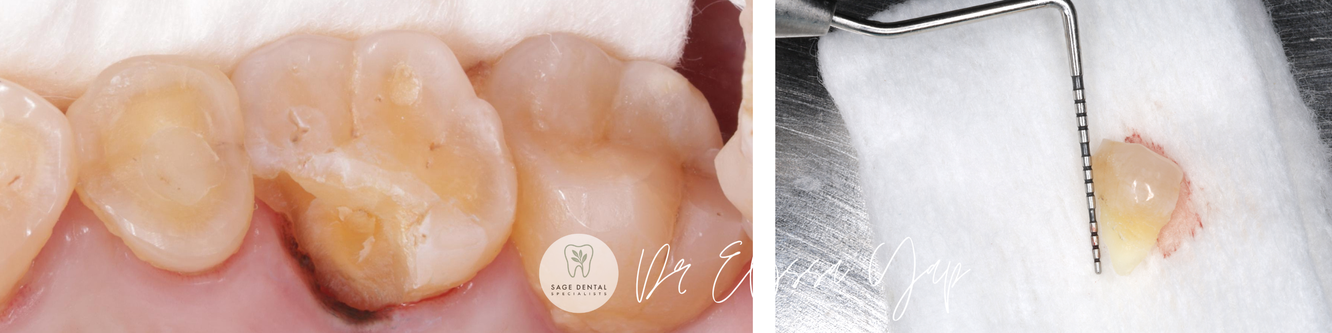fractured tooth molar