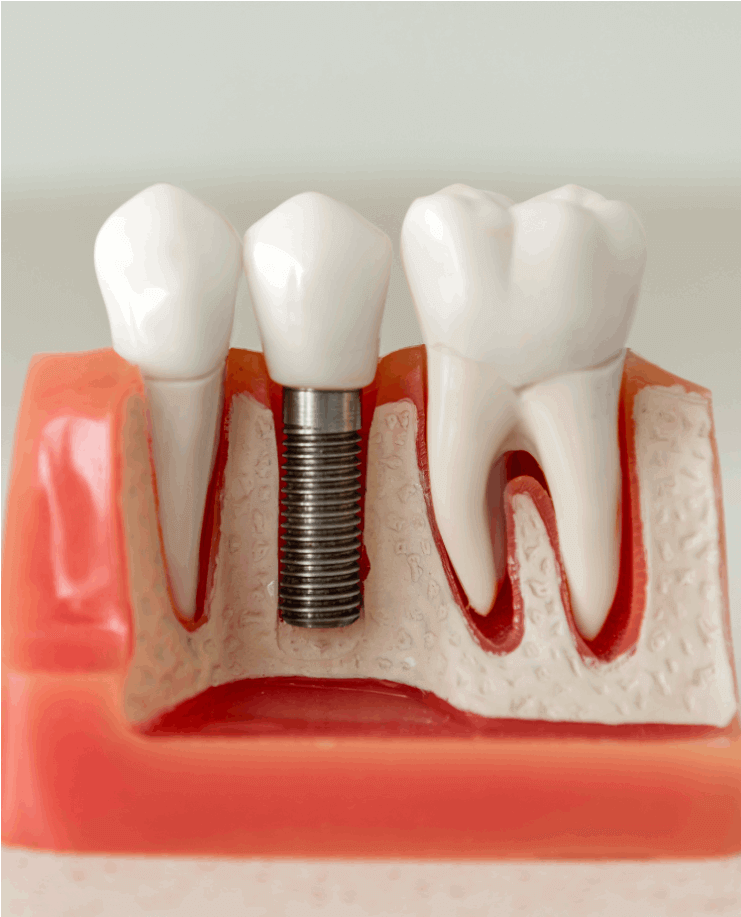 Dental Implant-1