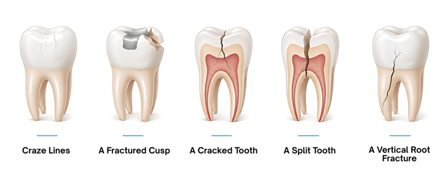 types of tooth cracks