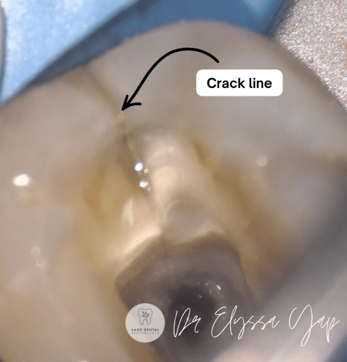crack line running down a tooth