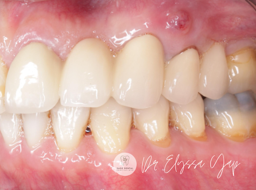 gum boil sinus tract on gums infection