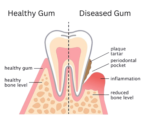 image showing bone levels in healthy and diseased tooth