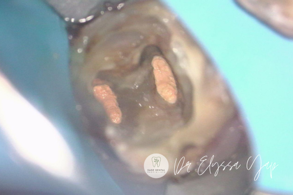root canals disinfected and resealed