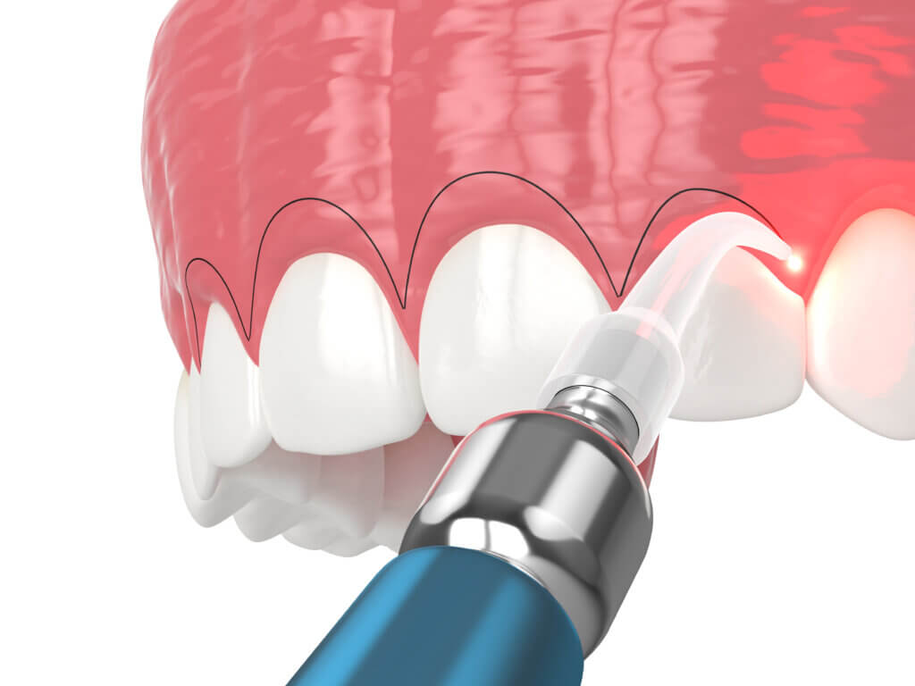 gummy smile gum reshaping with laser