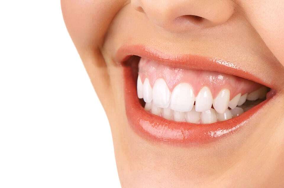 gummy smile image example