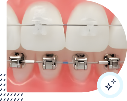 Illustration of ceramic and metal self-ligating brackets from the Dental Designs braces page